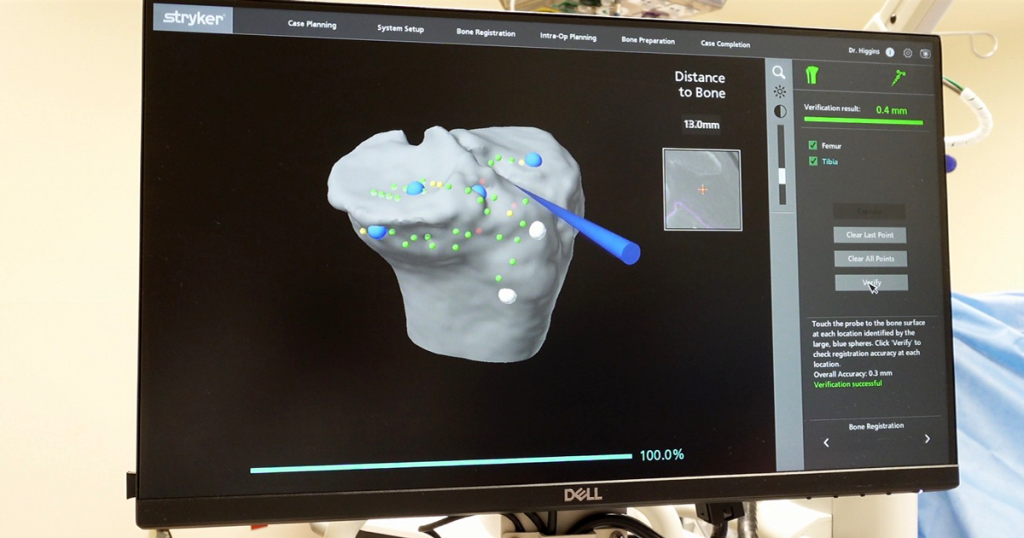 Stryker Mako Robotics Knee Replacement Computer Screen Distance to Bone