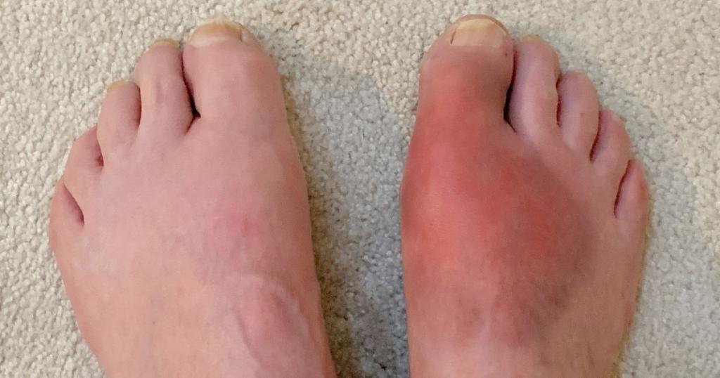 Two feet one with gout top foot pain