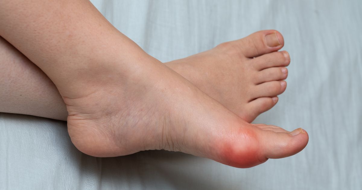 7 Signs You Have a Bunion and the Best Treatment Option